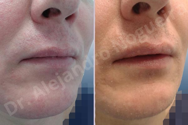 Small lips,Transgender lips,Lower lip autologous dermis collagen filler - photo 5