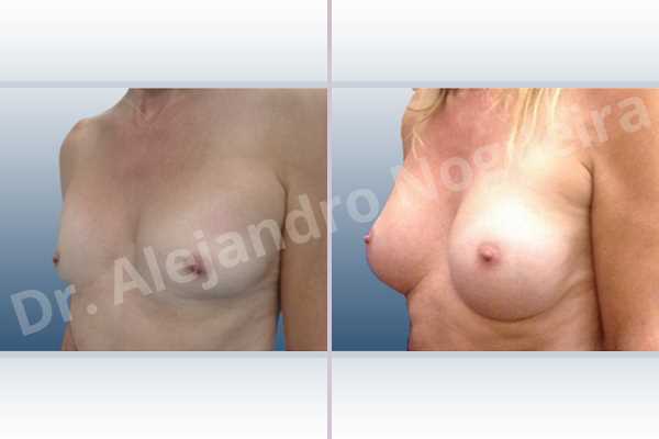 Asymmetric breasts,Cross eyed breasts,Empty breasts,Lateral breasts,Skinny breasts,Small breasts,Sunken chest,Too far apart wide cleavage breasts,Transgender breasts,Wide breasts,Anatomical shape,Inframammary incision,Subfascial pocket plane - photo 3
