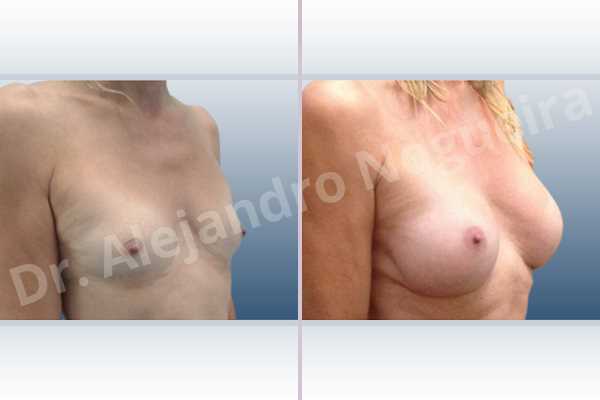 Asymmetric breasts,Cross eyed breasts,Empty breasts,Lateral breasts,Skinny breasts,Small breasts,Sunken chest,Too far apart wide cleavage breasts,Transgender breasts,Wide breasts,Anatomical shape,Inframammary incision,Subfascial pocket plane - photo 5