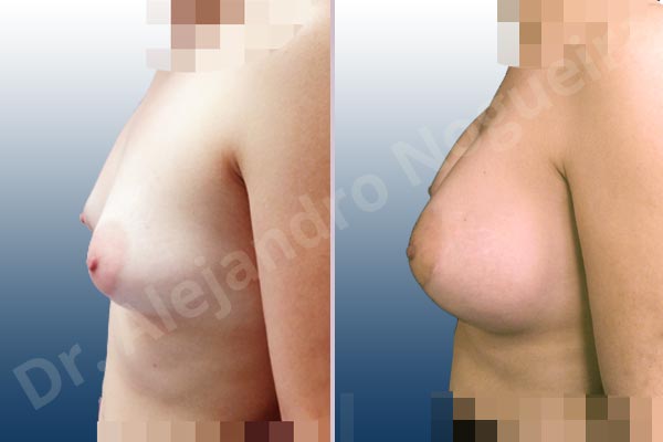 Asymmetric breasts,Cross eyed breasts,Empty breasts,Large areolas,Lateral breasts,Slightly saggy droopy breasts,Small breasts,Too far apart wide cleavage breasts,Tuberous breasts,Wide breasts,Anatomical shape,Lower hemi periareolar incision,Subfascial pocket plane,Tuberous mammoplasty - photo 2