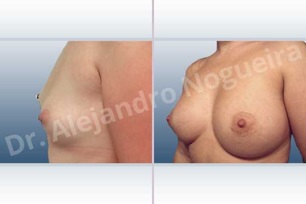 Asymmetric breasts,Lateral breasts,Small breasts,Too far apart wide cleavage breasts,Anatomical shape,Extra large size,Lower hemi periareolar incision,Subfascial pocket plane - photo 2