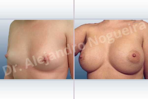 Asymmetric breasts,Lateral breasts,Small breasts,Too far apart wide cleavage breasts,Anatomical shape,Extra large size,Lower hemi periareolar incision,Subfascial pocket plane - photo 3