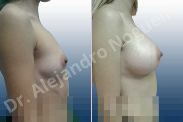 Empty breasts,Narrow breasts,Pigeon chest,Skinny breasts,Small breasts,Too far apart wide cleavage breasts,Anatomical shape,Extra large size,Lower hemi periareolar incision,Subfascial pocket plane - photo 4