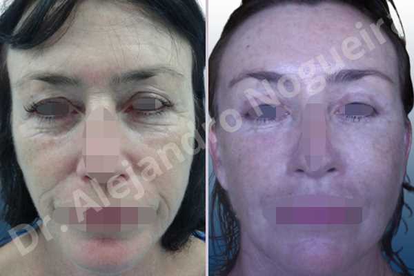 Baggy upper eyelids,Deep nasolabial folds,Droopy cheeks,Droopy eyebrows,Droopy face,Droopy forehead,Saggy upper eyelids,Short temporal incisions supraperiosteal extended lift of the upper two thirds of the face,Upper eyelid fat bags resection,Upper eyelid skin and muscle resection - photo 1