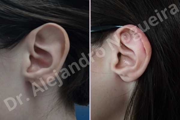 Large ears,Prominent ears,Fleur de lis cephalic ear resection - photo 1