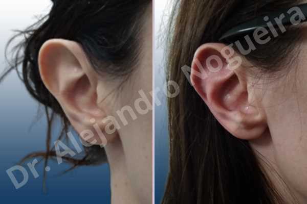 Large ears,Prominent ears,Fleur de lis cephalic ear resection - photo 4