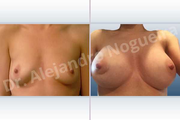 Empty breasts,Lateral breasts,Skinny breasts,Slightly saggy droopy breasts,Small breasts,Sunken chest,Too far apart wide cleavage breasts,Anatomical shape,Extra large size,Lower hemi periareolar incision,Subfascial pocket plane - photo 1