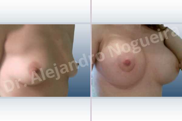 Empty breasts,Lateral breasts,Skinny breasts,Slightly saggy droopy breasts,Small breasts,Sunken chest,Too far apart wide cleavage breasts,Anatomical shape,Extra large size,Lower hemi periareolar incision,Subfascial pocket plane - photo 5