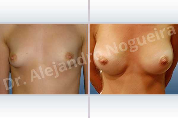 Asymmetric breasts,Lateral breasts,Narrow breasts,Pigeon chest,Skinny breasts,Small breasts,Too far apart wide cleavage breasts,Tuberous breasts,Anatomical shape,Lower hemi periareolar incision,Subfascial pocket plane,Tuberous mammoplasty - photo 1
