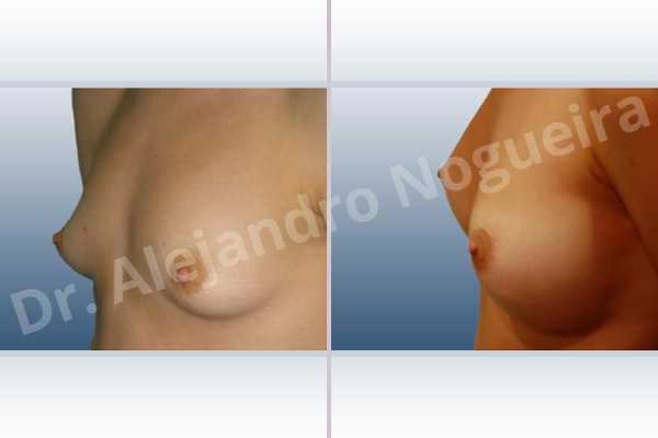 Asymmetric breasts,Lateral breasts,Narrow breasts,Pigeon chest,Skinny breasts,Small breasts,Too far apart wide cleavage breasts,Tuberous breasts,Anatomical shape,Lower hemi periareolar incision,Subfascial pocket plane,Tuberous mammoplasty - photo 2
