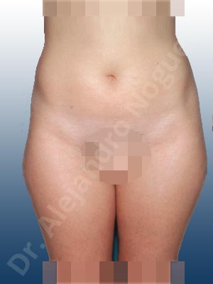 Fatty abdomen,Saddle bags flab,Tumescent liposuction