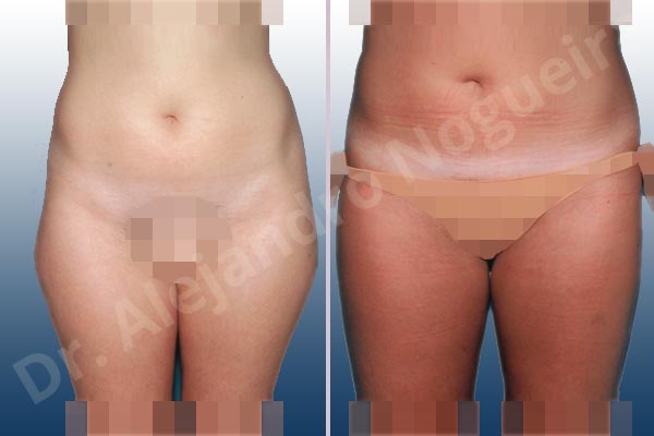 Fatty abdomen,Saddle bags flab,Tumescent liposuction - photo 1