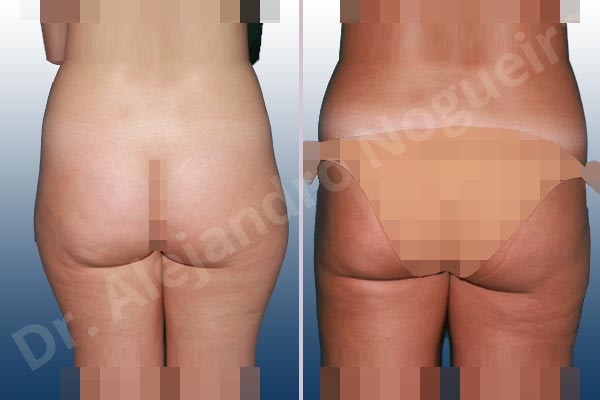Fatty abdomen,Saddle bags flab,Tumescent liposuction - photo 2