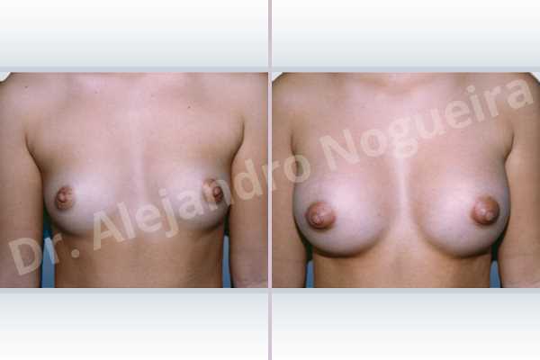 Cross eyed breasts,Lateral breasts,Narrow breasts,Small breasts,Tuberous breasts,Anatomical shape,Lower hemi periareolar incision,Subfascial pocket plane - photo 1