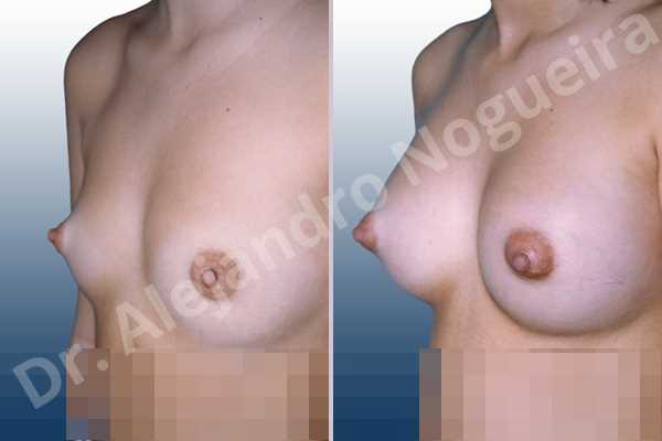 Cross eyed breasts,Lateral breasts,Narrow breasts,Small breasts,Tuberous breasts,Anatomical shape,Lower hemi periareolar incision,Subfascial pocket plane - photo 2