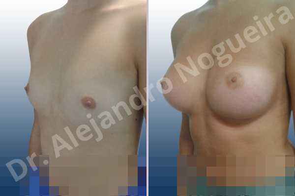 Cross eyed breasts,Empty breasts,Lateral breasts,Pigeon chest,Skinny breasts,Small breasts,Too far apart wide cleavage breasts,Wide breasts,Anatomical shape,Extra large size,Inframammary incision,Subfascial pocket plane - photo 3