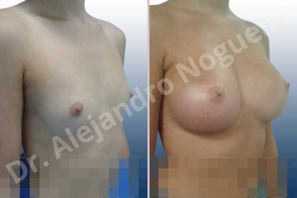 Cross eyed breasts,Empty breasts,Lateral breasts,Pigeon chest,Skinny breasts,Small breasts,Too far apart wide cleavage breasts,Wide breasts,Anatomical shape,Extra large size,Inframammary incision,Subfascial pocket plane - photo 5