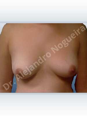 Asymmetric breasts,Lateral breasts,Mildly saggy droopy breasts,Moderately saggy droopy breasts,Small breasts,Waterfall effect breast implants,Anatomical shape,Lower hemi periareolar incision,Subfascial pocket plane