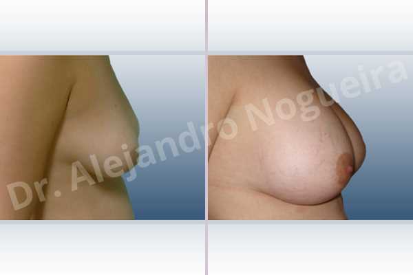 Asymmetric breasts,Lateral breasts,Mildly saggy droopy breasts,Moderately saggy droopy breasts,Small breasts,Waterfall effect breast implants,Anatomical shape,Lower hemi periareolar incision,Subfascial pocket plane - photo 3