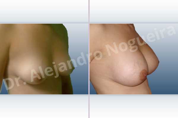 Asymmetric breasts,Lateral breasts,Mildly saggy droopy breasts,Moderately saggy droopy breasts,Small breasts,Waterfall effect breast implants,Anatomical shape,Lower hemi periareolar incision,Subfascial pocket plane - photo 4