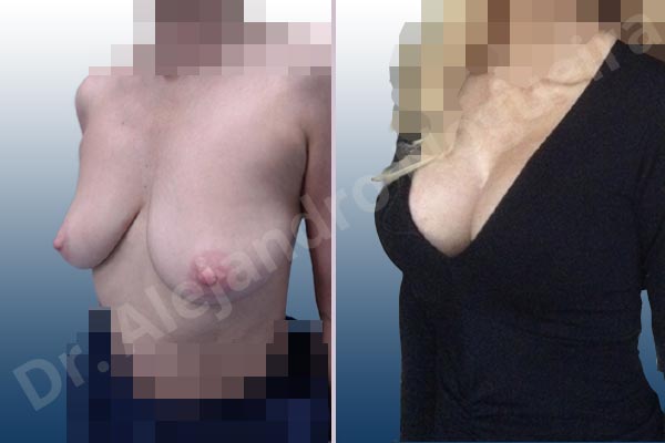 Empty breasts,Moderately saggy droopy breasts,Wide breasts,Anatomical shape,Lollipop incision,Subfascial pocket plane,Superior pedicle - photo 6