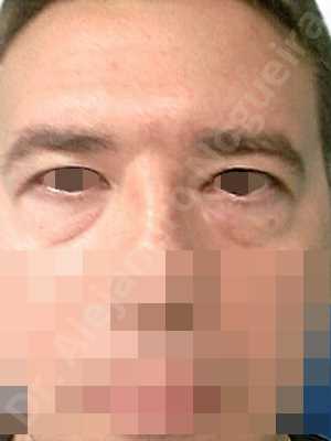 Baggy lower eyelids,Baggy upper eyelids,Saggy upper eyelids,Upper eyelids ptosis,Lower eyelid fat bags resection,Transconjunctival approach incision,Upper eyelid fat bags resection,Upper eyelid skin and muscle resection
