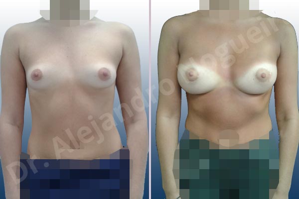 Asymmetric breasts,Empty breasts,Small breasts,Anatomical shape,Lower hemi periareolar incision,Subfascial pocket plane - photo 1