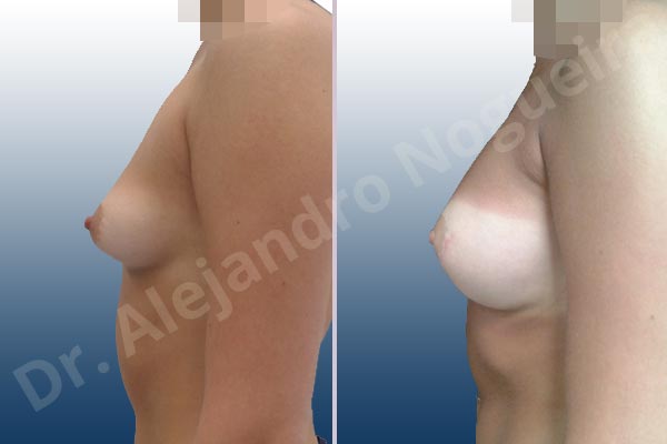 Asymmetric breasts,Empty breasts,Small breasts,Anatomical shape,Lower hemi periareolar incision,Subfascial pocket plane - photo 2
