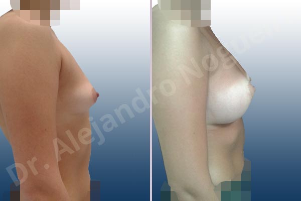 Asymmetric breasts,Empty breasts,Small breasts,Anatomical shape,Lower hemi periareolar incision,Subfascial pocket plane - photo 4
