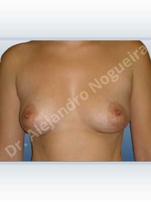 Asymmetric breasts,Cross eyed breasts,Lateral breasts,Small breasts,Tuberous breasts,Anatomical shape,Lower hemi periareolar incision,Subfascial pocket plane,Tuberous mammoplasty