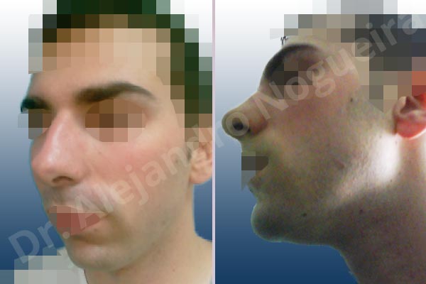 Broad dorsum,Broad nose,Dorsum hump,Large alar cartilages,Large nose,Long nose,Long upper lateral cartilages,Mediterranean nose,Overprojected tip,Small chin,Weak chin,Closed approach incision,Dorsum hump resection,Horizontal chin osteotomy,Lateral cruras cephalic resection,Lateral cruras shortening resection,Medial cruras shortening resection,Nasal bones osteotomies,One dimensional genioplasty,Osseous chin advancement,Triangular cartilages caudal resection - photo 3