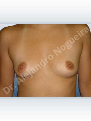 Asymmetric breasts,Cross eyed breasts,Empty breasts,Narrow breasts,Small breasts,Anatomical shape,Extra large size,Lower hemi periareolar incision,Subfascial pocket plane