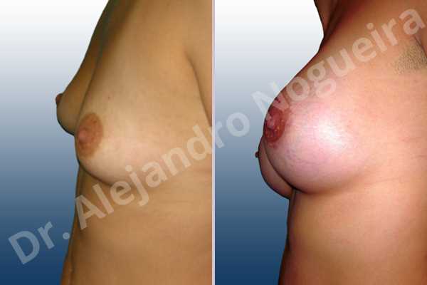 Asymmetric breasts,Cross eyed breasts,Empty breasts,Narrow breasts,Small breasts,Anatomical shape,Extra large size,Lower hemi periareolar incision,Subfascial pocket plane - photo 2