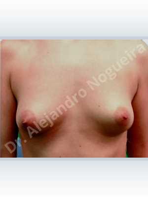 Lateral breasts,Narrow breasts,Small breasts,Too far apart wide cleavage breasts,Tuberous breasts,Anatomical shape,Lower hemi periareolar incision,Subfascial pocket plane,Tuberous mammoplasty