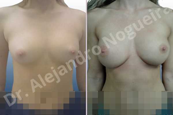 Asymmetric breasts,Cross eyed breasts,Narrow breasts,Small breasts,Anatomical shape,Inframammary incision,Subfascial pocket plane - photo 1