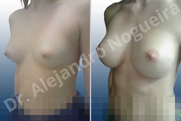 Asymmetric breasts,Cross eyed breasts,Narrow breasts,Small breasts,Anatomical shape,Inframammary incision,Subfascial pocket plane - photo 3