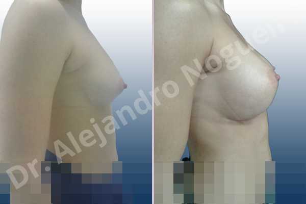 Asymmetric breasts,Cross eyed breasts,Narrow breasts,Small breasts,Anatomical shape,Inframammary incision,Subfascial pocket plane - photo 4
