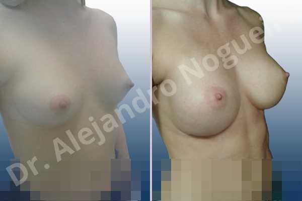 Asymmetric breasts,Cross eyed breasts,Narrow breasts,Small breasts,Anatomical shape,Inframammary incision,Subfascial pocket plane - photo 5