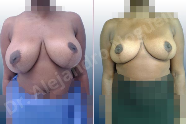 Asymmetric breasts,Cross eyed breasts,Displaced malpositioned scars,Failed breast reduction,Hypertrophic scars,Keloid scars,Lateral breasts,Pendulous breasts,Pigmented scars,Severely large breasts,Too far apart wide cleavage breasts,Wide scars,Anchor incision,Custom incision,Excisional scar revision,Superior pedicle - photo 1