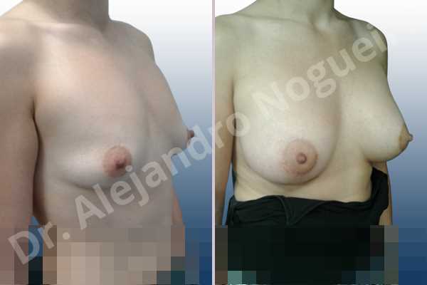 Empty breasts,Lateral breasts,Pigeon chest,Small breasts,Too far apart wide cleavage breasts,Wide breasts,Anatomical shape,Lower hemi periareolar incision,Subfascial pocket plane - photo 5