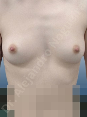 Asymmetric breasts,Lateral breasts,Skinny breasts,Small breasts,Sunken chest,Too far apart wide cleavage breasts,Anatomical shape,Inframammary incision,Subfascial pocket plane