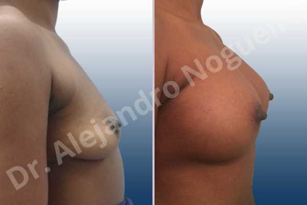 Empty breasts,Lateral breasts,Slightly saggy droopy breasts,Small breasts,Anatomical shape,Lower hemi periareolar incision,Subfascial pocket plane - photo 4