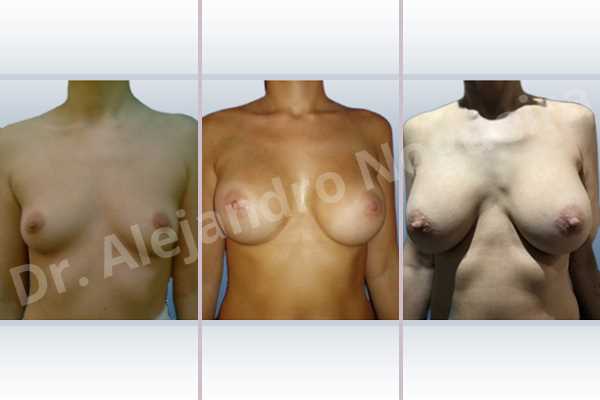 Empty breasts,Lateral breasts,Narrow breasts,Skinny breasts,Small breasts,Too far apart wide cleavage breasts,Dual plane pocket,Lower hemi periareolar incision,Round shape - photo 1