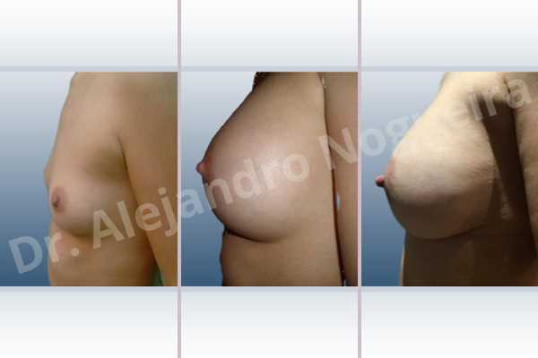 Empty breasts,Lateral breasts,Narrow breasts,Skinny breasts,Small breasts,Too far apart wide cleavage breasts,Dual plane pocket,Lower hemi periareolar incision,Round shape - photo 2