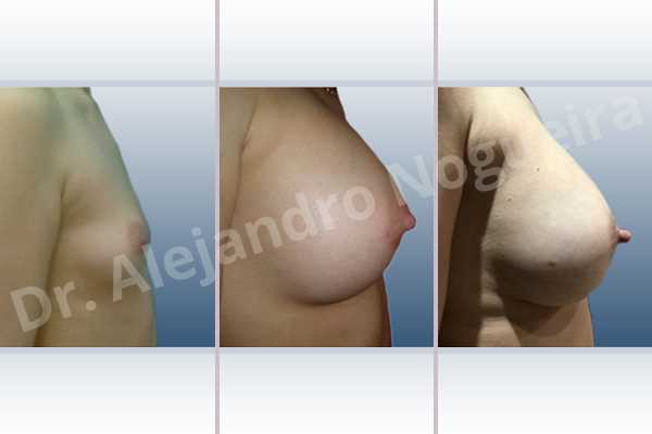 Empty breasts,Lateral breasts,Narrow breasts,Skinny breasts,Small breasts,Too far apart wide cleavage breasts,Dual plane pocket,Lower hemi periareolar incision,Round shape - photo 3