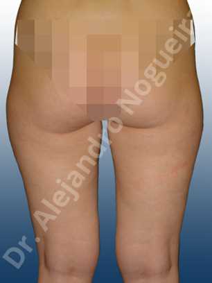 Banana rolls flab,Fatty inner knee,Saddle bags flab,Thigh gap flab,Tumescent liposuction