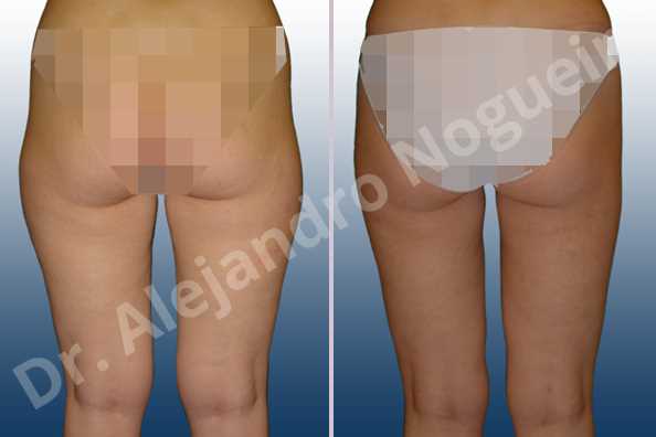 Banana rolls flab,Fatty inner knee,Saddle bags flab,Thigh gap flab,Tumescent liposuction - photo 2