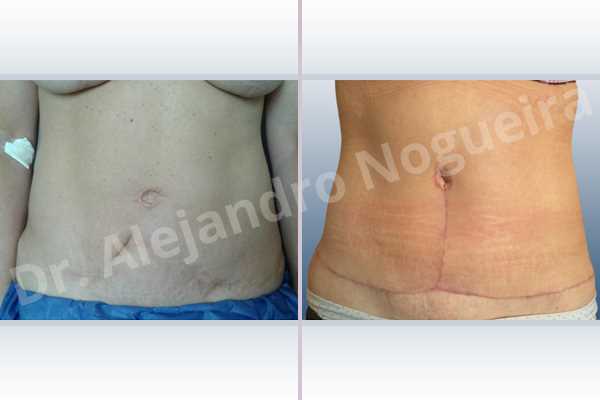 Displaced malpositioned scars,Failed tummy tuck,Hypertrophic scars,Keloid scars,Sunken scars,Wide scars,Excisional scar revision,Fleur de lis abdominoplasty - photo 1
