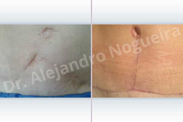 Displaced malpositioned scars,Failed tummy tuck,Hypertrophic scars,Keloid scars,Sunken scars,Wide scars,Excisional scar revision,Fleur de lis abdominoplasty - photo 2