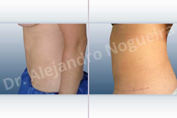 Displaced malpositioned scars,Failed tummy tuck,Hypertrophic scars,Keloid scars,Sunken scars,Wide scars,Excisional scar revision,Fleur de lis abdominoplasty - photo 3